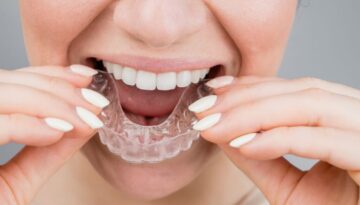 Close-up portrait of a woman putting on a transparent plastic retainer. A girl corrects a bite with the help of an orthodontic device