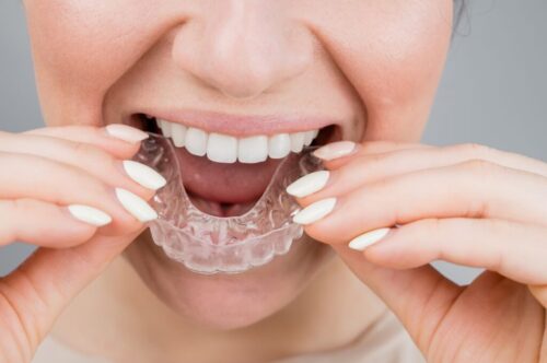 Close-up portrait of a woman putting on a transparent plastic retainer. A girl corrects a bite with the help of an orthodontic device