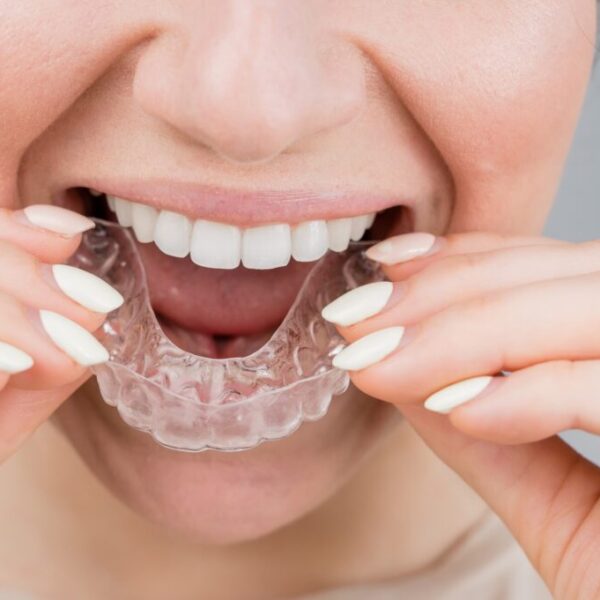 Close-up portrait of a woman putting on a transparent plastic retainer. A girl corrects a bite with the help of an orthodontic device