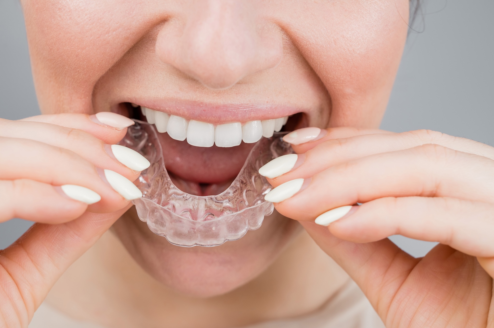 Close-up portrait of a woman putting on a transparent plastic retainer. A girl corrects a bite with the help of an orthodontic device